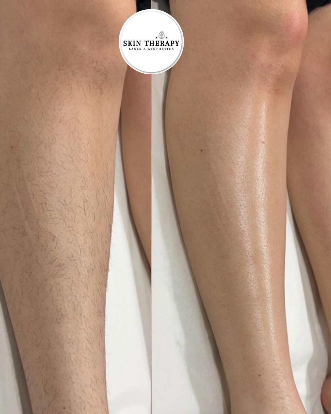 LASER HAIR REMOVAL