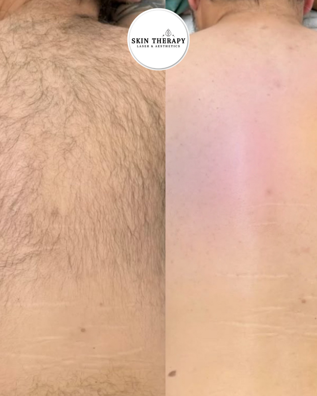 LASER HAIR REMOVAL