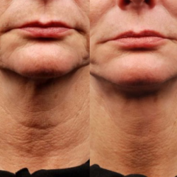SAGGY NECK BA